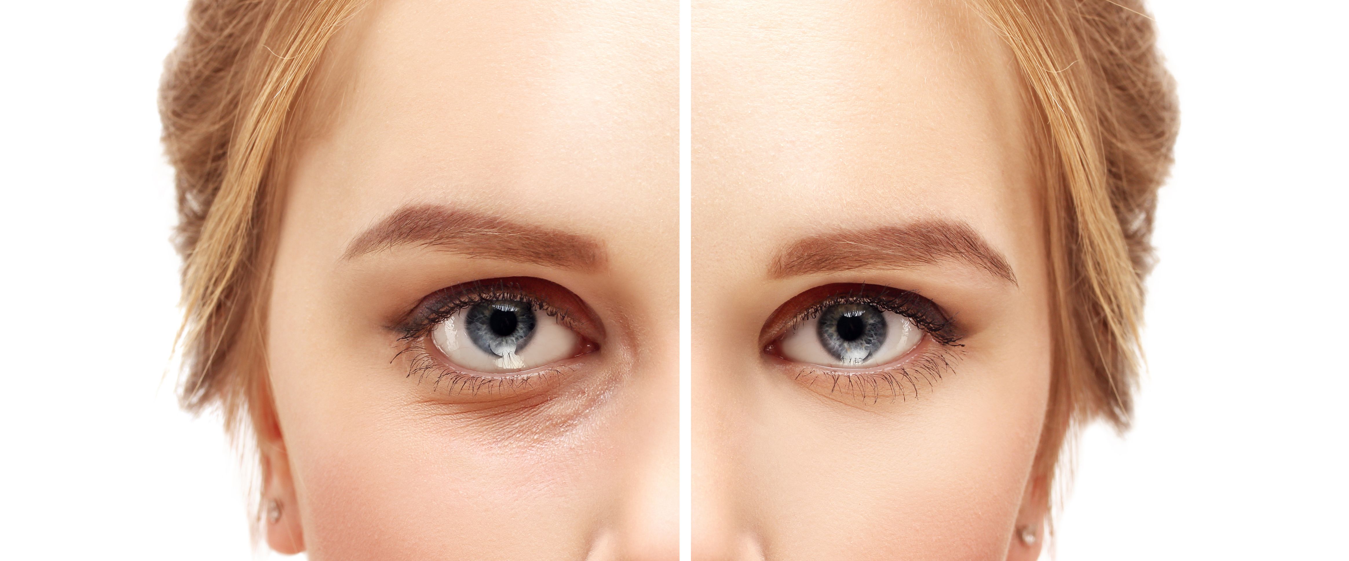 Before and After Blepharoplasty Lower Eyelid Surgery